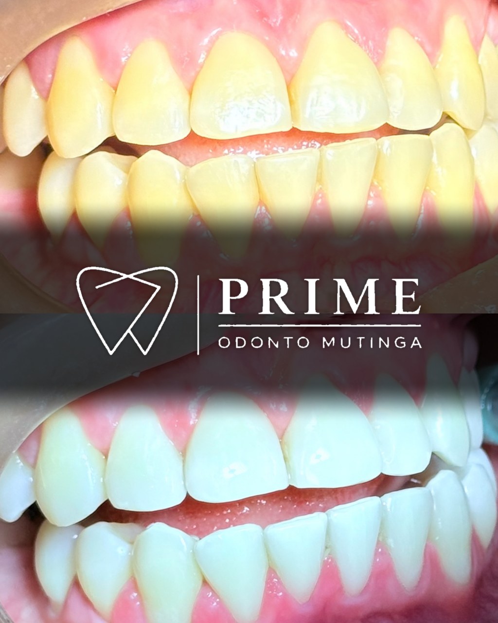 Clareamento dental — antes e depois
