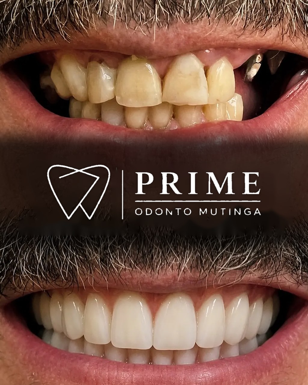 Protocolo carga imediata — antes e depois