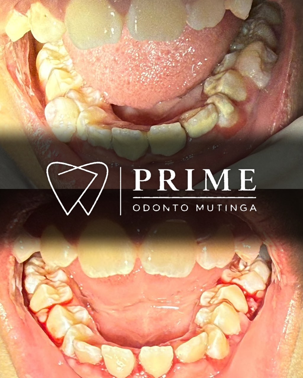 Limpeza infantil e extração de decíduos (dente de leite) — antes e depois