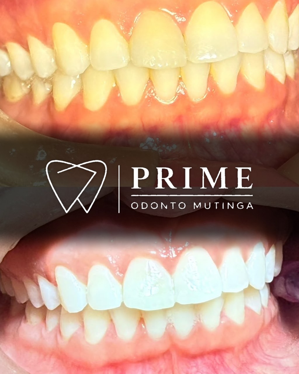 Clareamento dental — antes e depois