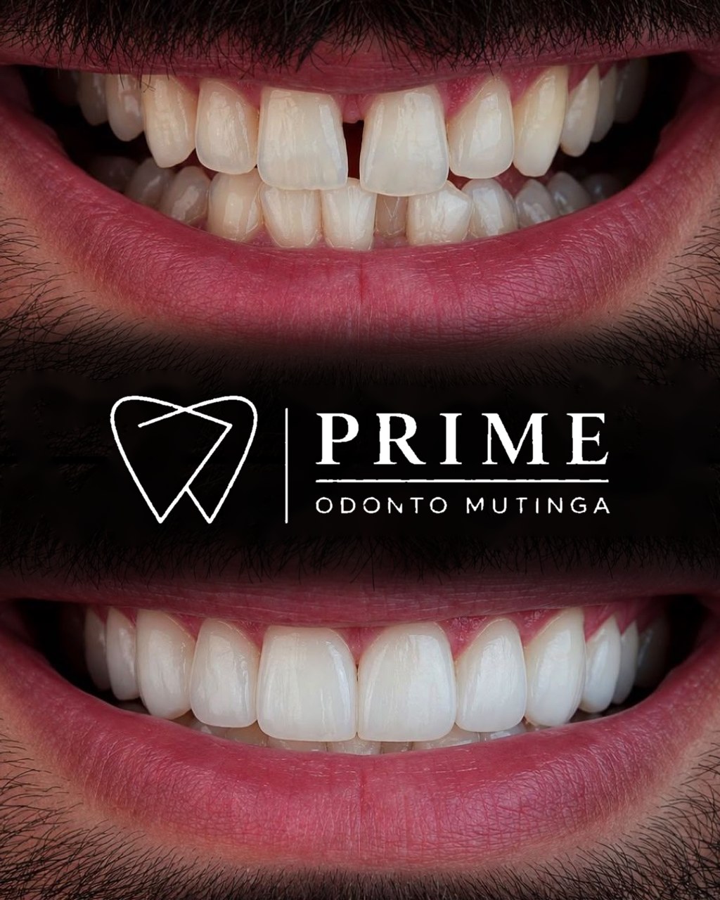 Reabilitação estética do sorriso — antes e depois